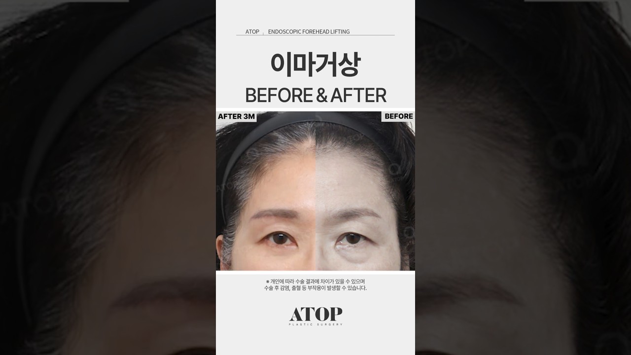 [Viện thẩm mỹ Atop] Nâng cung mày_Đánh giá 6