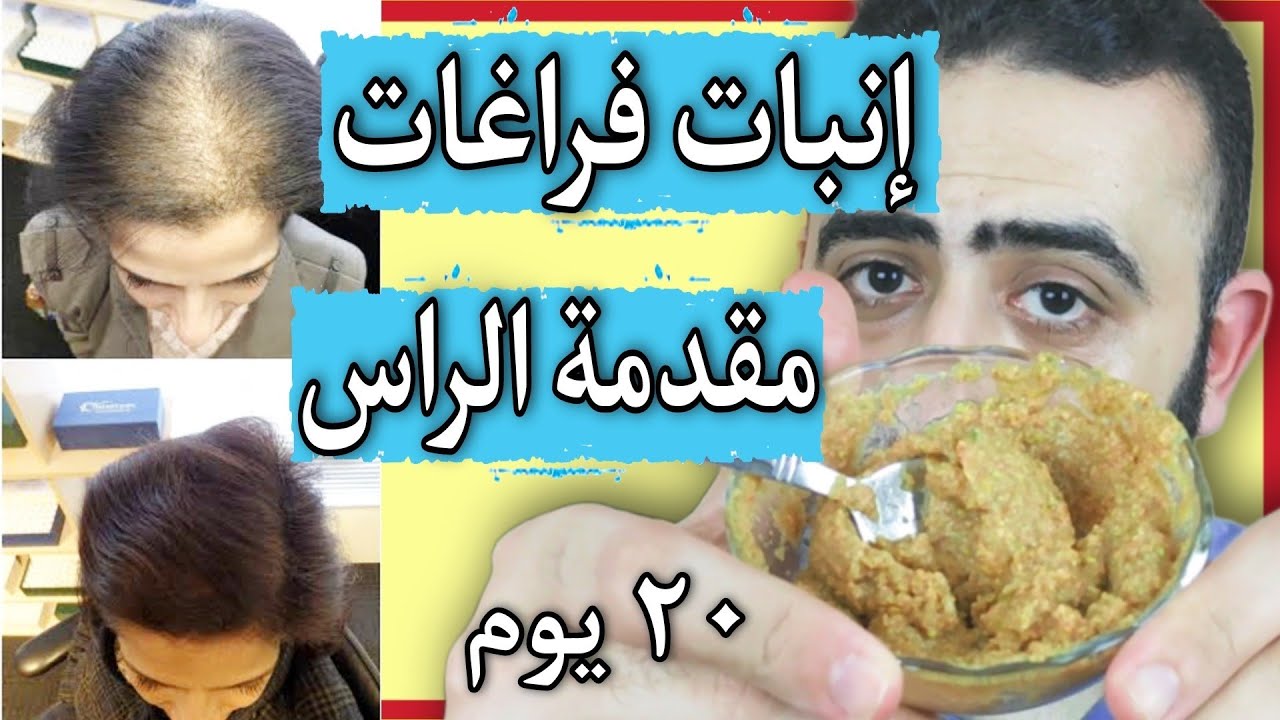 الحل الامثل لانبات الشعر في مقدمة الراس و صلع الجوانب و تكثيف و اطالة الشعر في 20 يوم