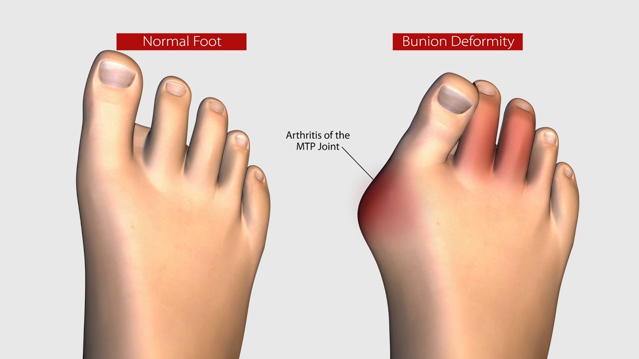 bunion treatment