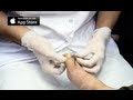 Ingrown Toenail Removal Surgery