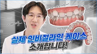 ⭐투명교정 인비절라인 효과 | 인비절라인 라이트🦷 (feat.옥니,치아재교정)
