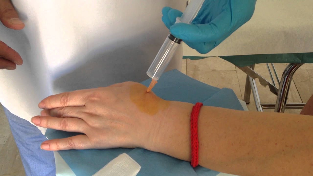 Artrodiastasis en Rizartrosis con Ozono Medico. - YouTube