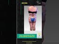 Vaser Liposuction of back and Fat Grafting To Buttocks | #liposuctionbeforeandafter