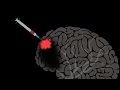 The brain may be able to repair itself -- with help | Jocelyne Bloch
