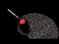 The Brain May Be Able To Repair Itself With Help Jocelyne Bloch The Brain May Be Able To Repair Itself With Help Jocelyne Bloch