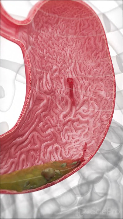 A peptic ulcer is a sore in the lining of the stomach or duodenum.  #medicalanimation #anatomy