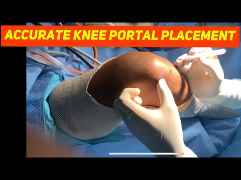 Basic portal placement in Arthroscopy.