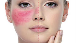 8 Dermatologist Skincare Tips For Rosacea + Product Recommendations