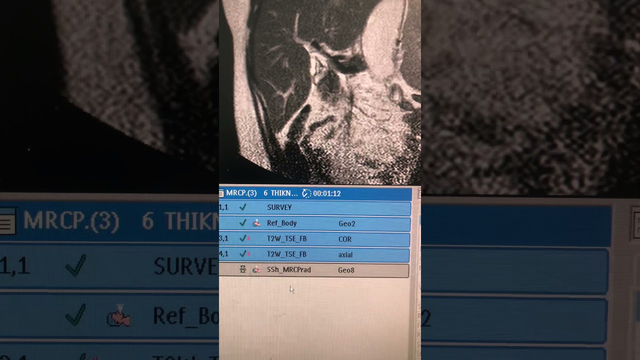 MRCP تصوير القنوات الصفراوية وقناة البنكرياس بالرنين المغناطيسي