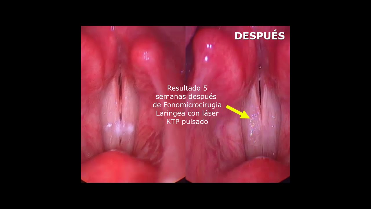 TRATAMIENTO NÓDULOS DEL CANTANTE⁣ - NÓDULOS DE CUERDAS VOCALES - VOCAL
