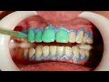 Clareamento combinado e fechamento de diastema em resina composta Vittra APS