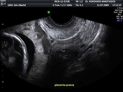 Προδρομικός πλακούντας | Placenta previa