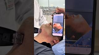 Un resultado con #lipopapada con #facetite y #morpheus8 #belleza