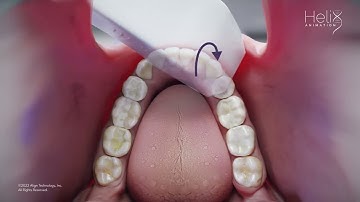 Align iTero Training Video - initial 8min on a normal/standard anatomy