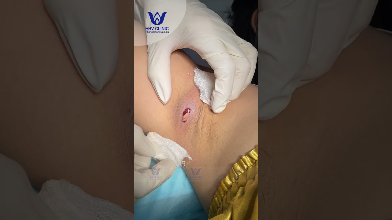 Xử lý u nang nách đúng cách tránh biến chứng và sẹo xấu