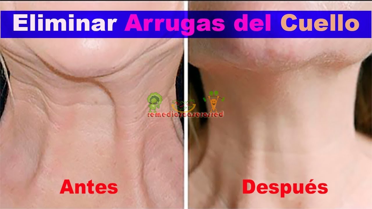 enfermedad de abel ayala COMO QUITAR O ELIMINAR ARRUGAS DEL CUELLO
