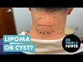 Lipoma or Cyst? Dr Pimple Popper Finds Out