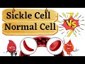 Sickle cell anemia  animation  mlt tutelage