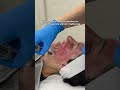 #microneedling