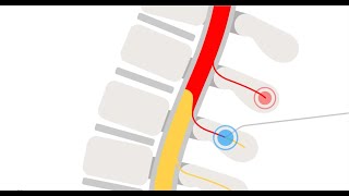 Boston Scientific: How Radiofrequency Ablation (RFA) Works