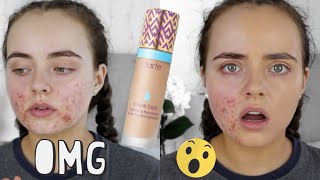 TARTE SHAPE TAPE FOUNDATION REVIEW | ACNE PRONE SKIN | Conagh Kathleen