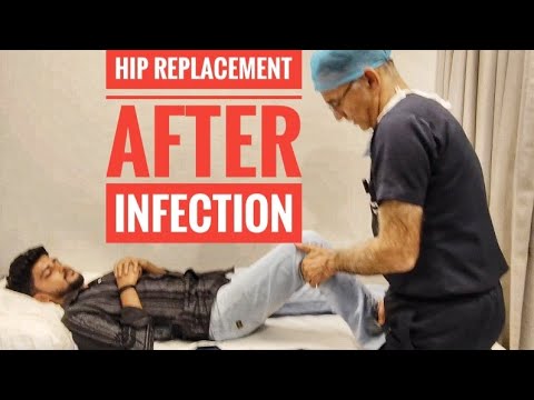 After 8 surgeries Gaurav gets a new Hip