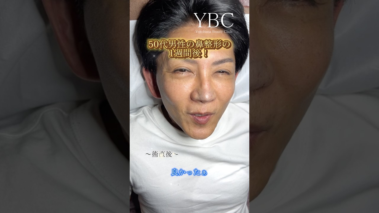 1 Week After Nose Surgery for a Man in His 50s! #Rhinoplasty