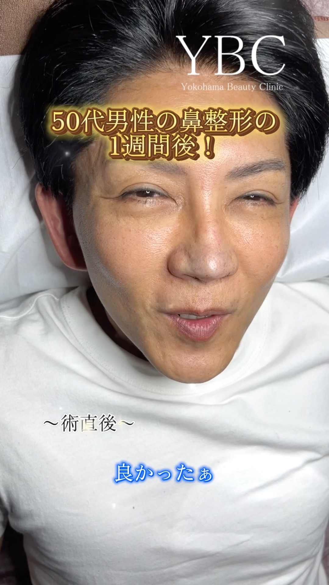 1 Week After Nose Surgery for a Man in His 50s! #Rhinoplasty