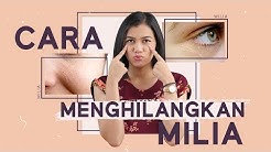 Begini Cara Menghilangkan Dan Mengatasi Milia Pada Wajah - Durasi: 4.55. 