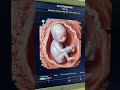 kidney infection week 10 pregnancy #Week10Pregnancy #PregnancyShorts