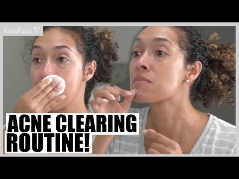 how-i-cleared-my-skin-from-acne---full-skin-care-routine---**not-sponsored!!!**