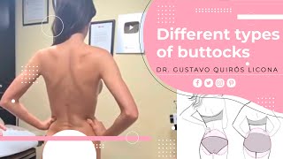 Tipos De Glúteos / Different Types Of Buttocks