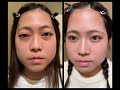甲状腺眼症　減圧術前後　Aesthetic Orbital Decompression for Thyroid Eye Disease