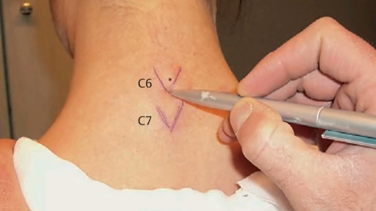 Bloqueo cervical para el dolor, mejoria instantánea