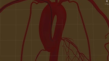 Cosserat Rods sliding, Catheter and guidewire simulation