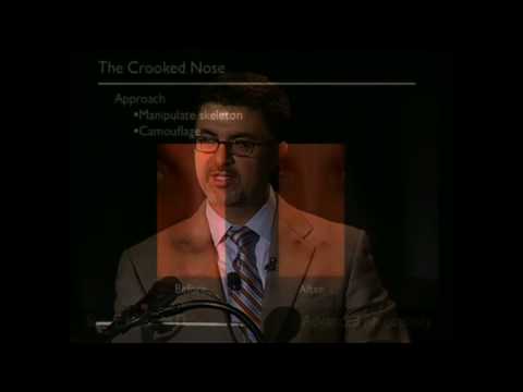 Video thumbnail: San Francisco Advanced Rhinoplasty (Part 8 - The Crooked Nose) · sammost
