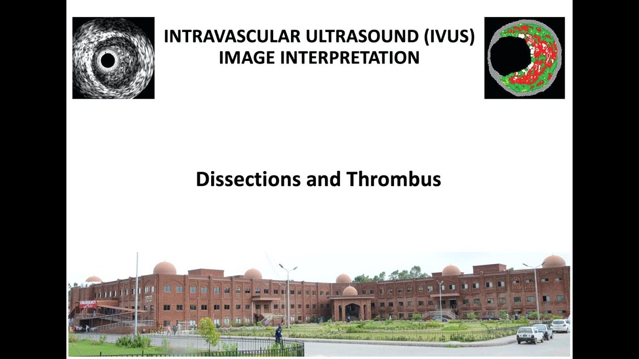 3. Dissections and Thrombus on IVUS