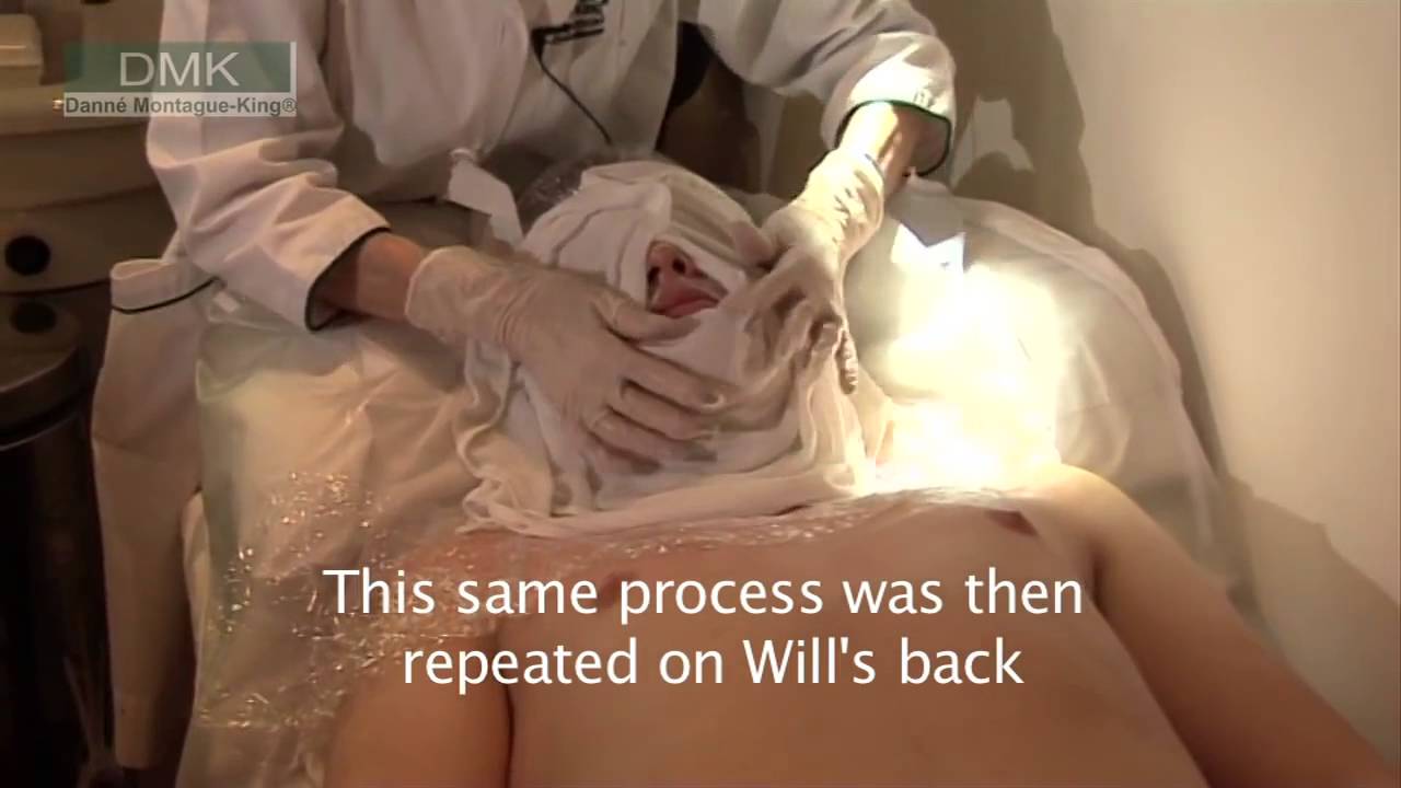 45 Dying For Clear Skin   Will's Story