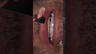 SMILE MAKEOVER #dentalmakeover #bestdentist #dentistry #transformation #allon4 #dentist