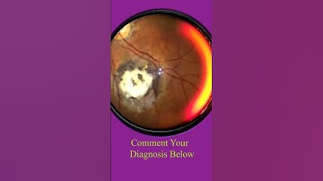 Smartphone Fundus Videography | Fundus Photography | Short Video 4