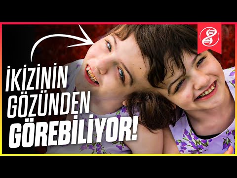 Yapışık Beyinli İkizler, Birbirinin Düşüncelerini Okuyup, Gözlerinden Görebiliyor!