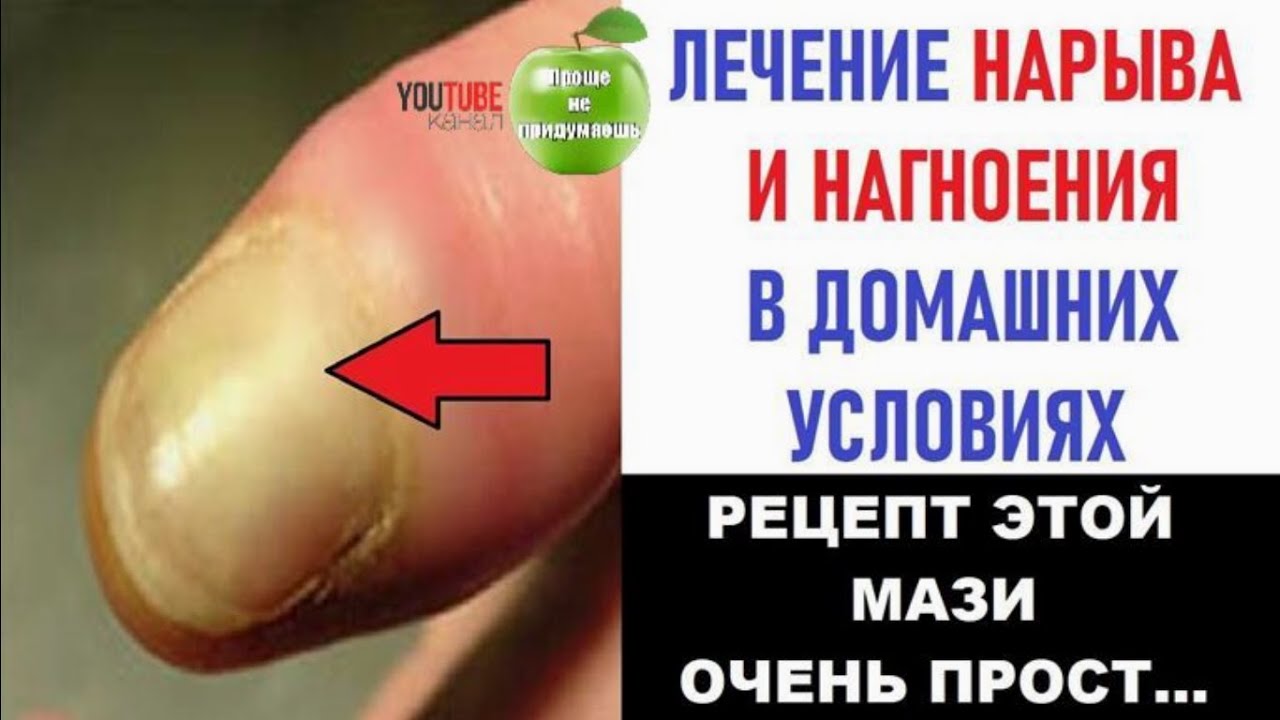 Старинный рецепт лечения нарыва и нагноения. Вытягивает всю гадость из ...