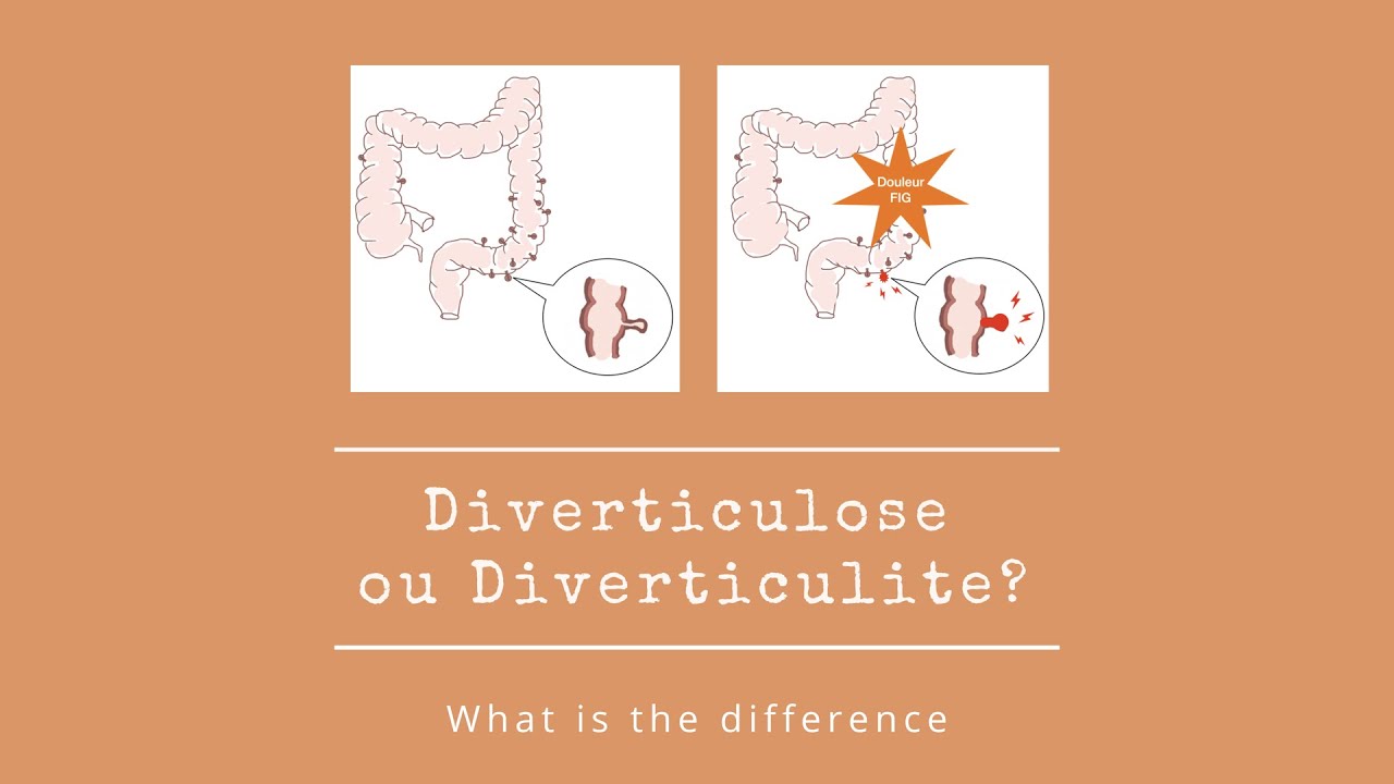 Diverticulose ou diverticulite colique ?