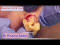 Massive Face Cyst Removal. LipomaCyst.com Dr Khaled Sadek London