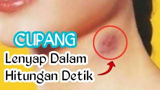 Cara Menghilangkan Bekas Cupang Dengan Cepat - Sahabat Herbal