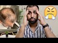 2 Month Turkey Hair Transplant UPDATE... IT GOT WORSE!