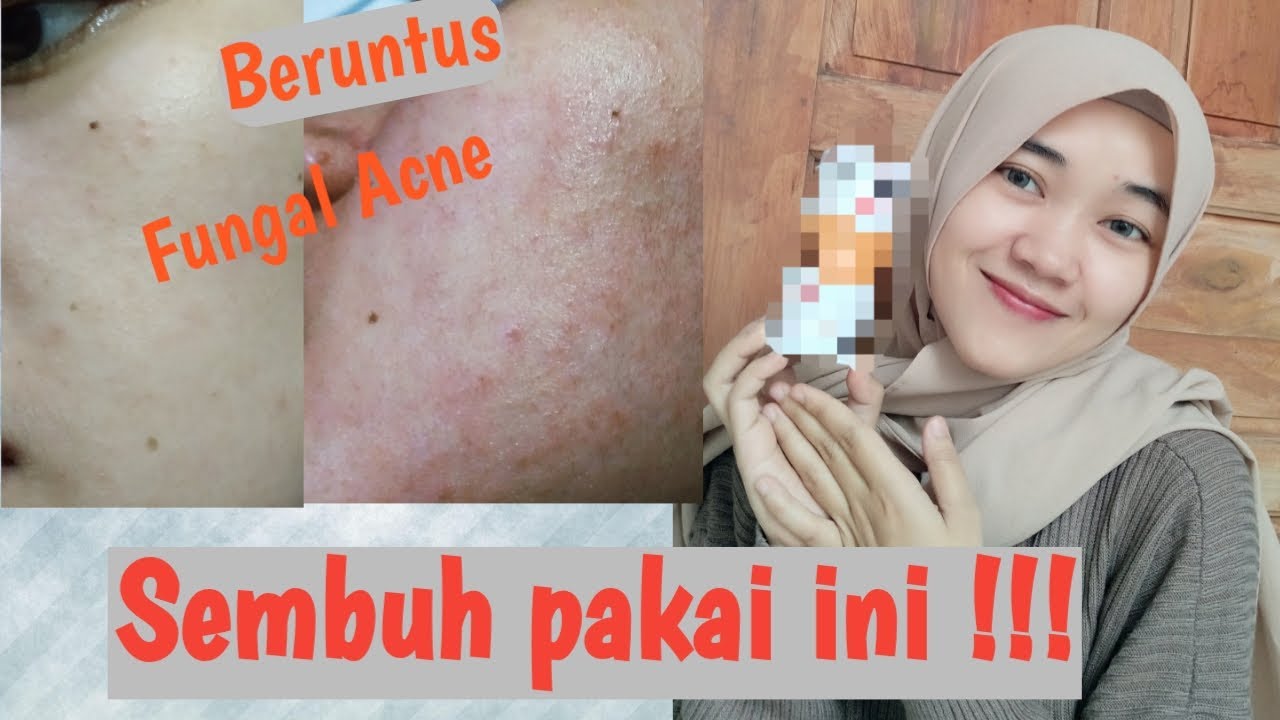 Mengobati Fungal acne (beruntus,gatal&merah) tanpa obat dokter 