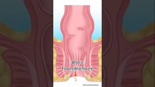 What is Anal Fissure?