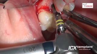 Oberkiefer Sinuslift Implantate Restaurationszahn Übungsmodell Dentalform 2,36 