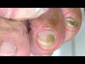 3 of 5 toes were infected【DrZhang】